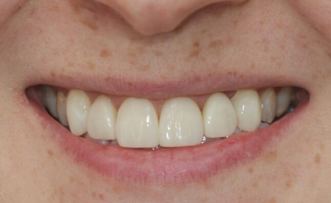 After - Buttercross Dental Practice