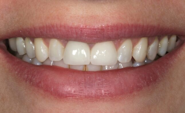 After - Buttercross Dental Practice